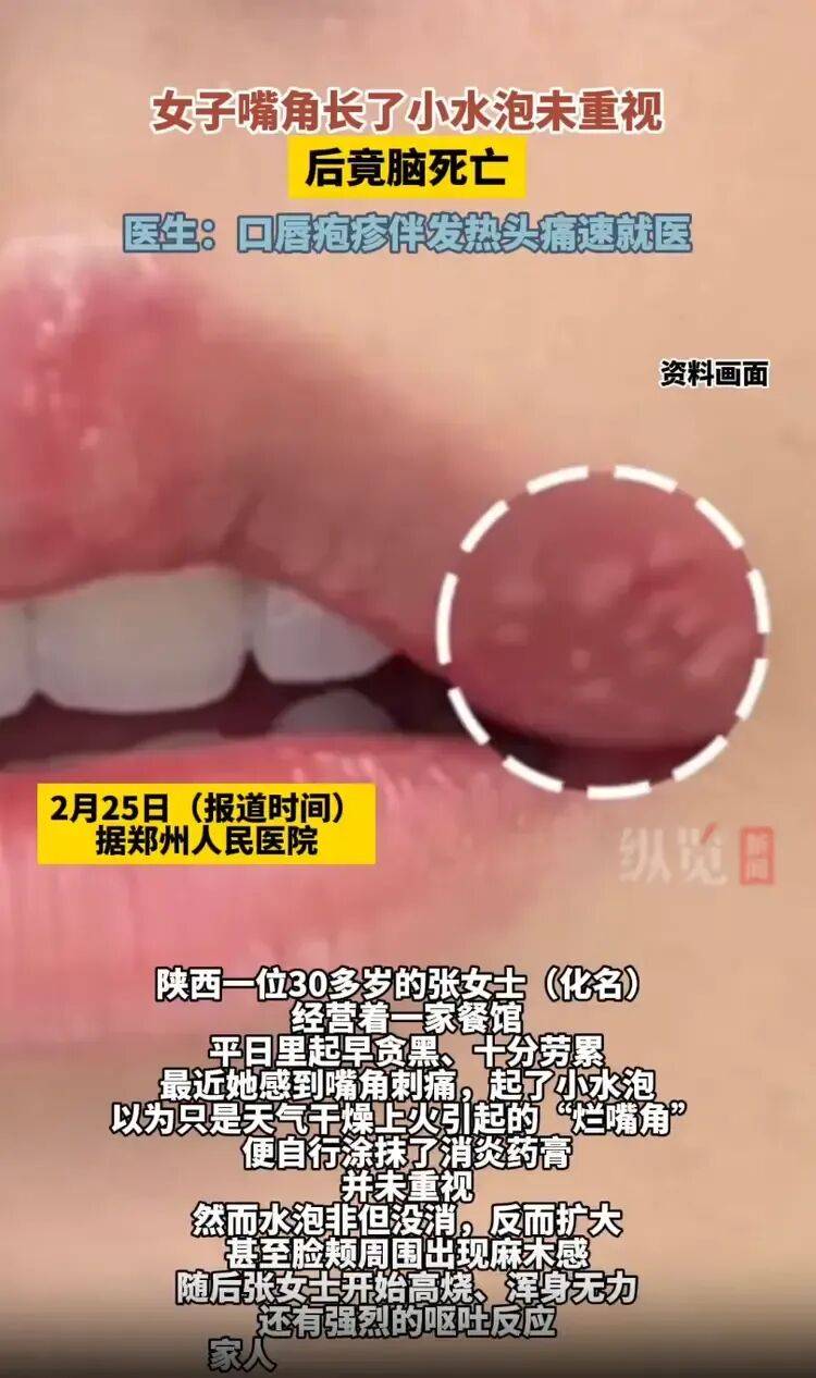 女子嘴角起泡未重视竟导致脑死亡，医生紧急提醒：口唇疱疹伴发热头痛速就医:车载保险箱哪家好